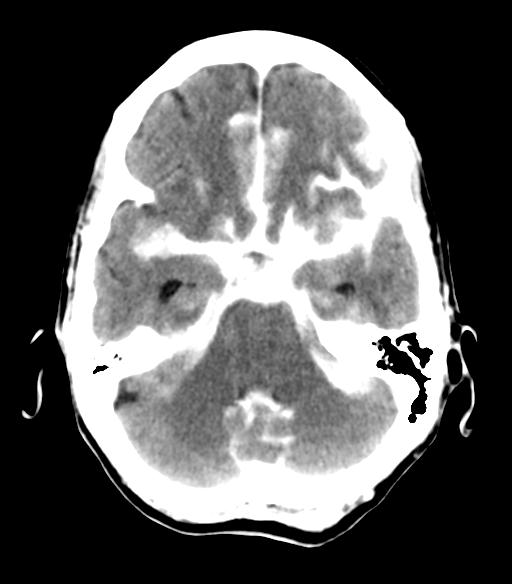 File:Cerebral aneurysm with rupture (Radiopaedia 29933-30460 Axial non-contrast 8).jpg