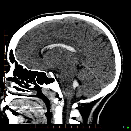 Cerebral arteriovenous malformation (AVM) (Radiopaedia 78162-90706 A 37).jpg