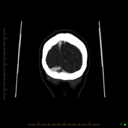 Cerebral arteriovenous malformation (AVM) (Radiopaedia 78162-90706 Coronal CTA 12).jpg