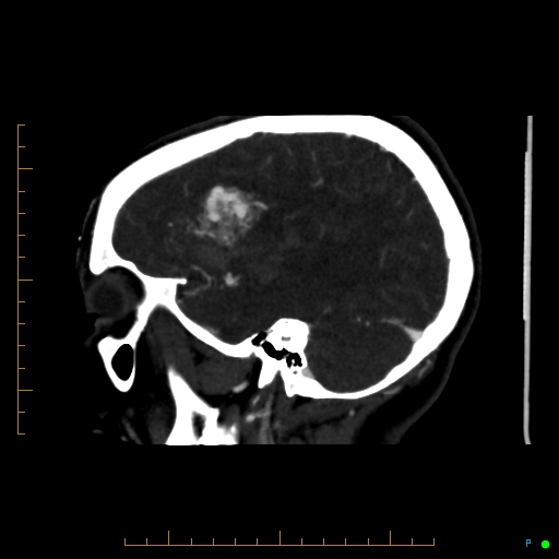 Cerebral arteriovenous malformation (AVM) (Radiopaedia 78162-90706 Sagittal CTA 22).jpg