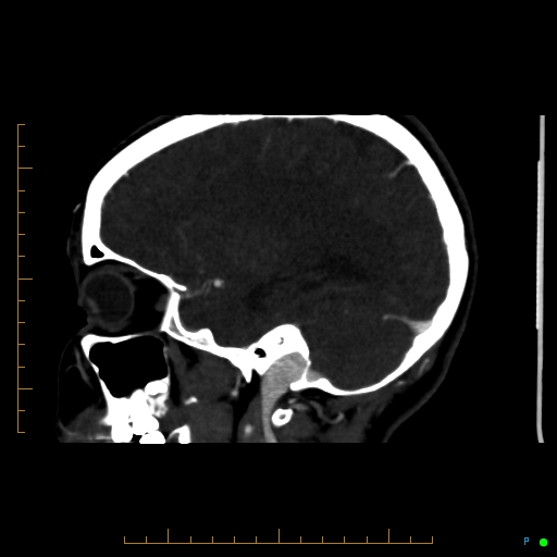 Cerebral arteriovenous malformation (AVM) (Radiopaedia 78162-90706 Sagittal CTA 56).jpg