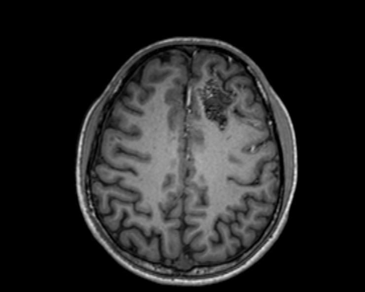 Cerebral arteriovenous malformation (Radiopaedia 30198-30813 Axial T1 24).jpg