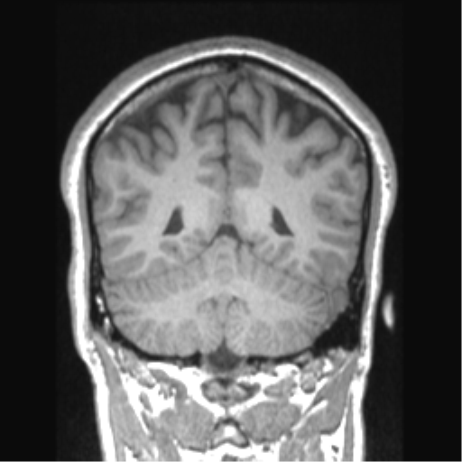 Cerebral arteriovenous malformation (Radiopaedia 39259-41506 Coronal T1 30).png