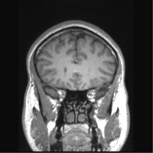 Cerebral arteriovenous malformation (Radiopaedia 39259-41506 Coronal T1 68).png
