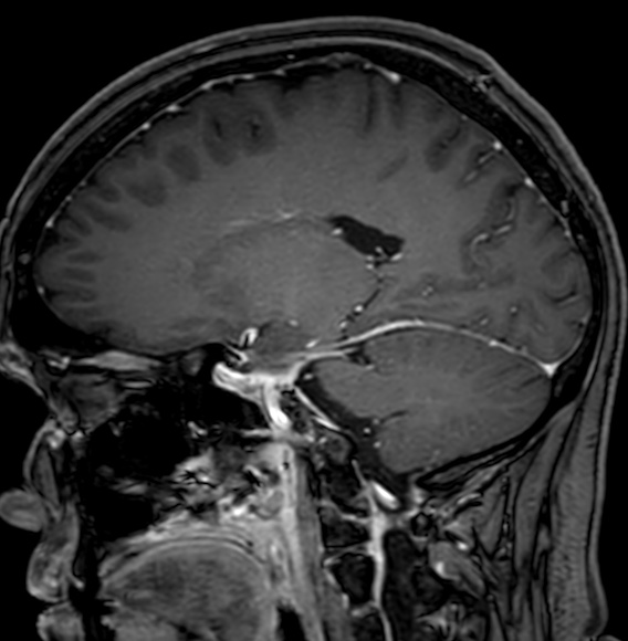 Cerebral arteriovenous malformation (Radiopaedia 74411-85746 Sagittal T1 C+ 50).jpg