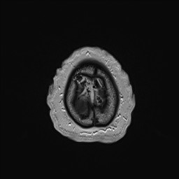 Cerebral arteriovenous malformation (Radiopaedia 84015-99245 Axial T1 C+ 147).jpg