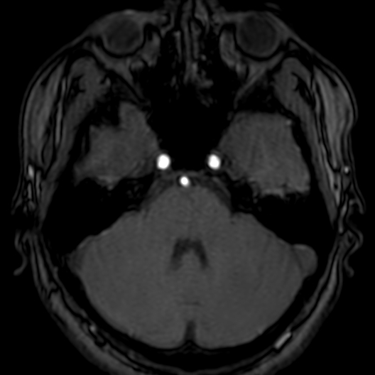 Cerebral arteriovenous malformation at posterior body of corpus callosum (Radiopaedia 74111-84925 Axial MRA 48).jpg
