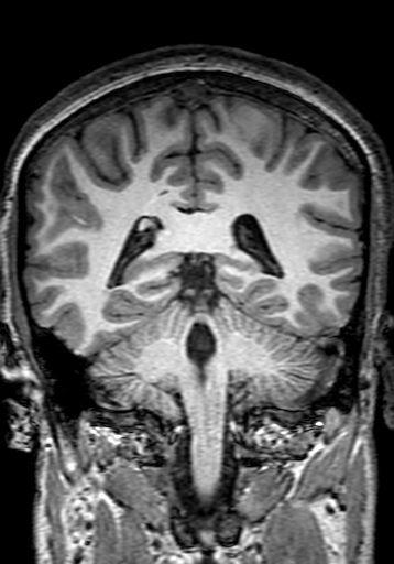 Cerebral arteriovenous malformation at posterior body of corpus callosum (Radiopaedia 74111-84925 Coronal T1 224).jpg