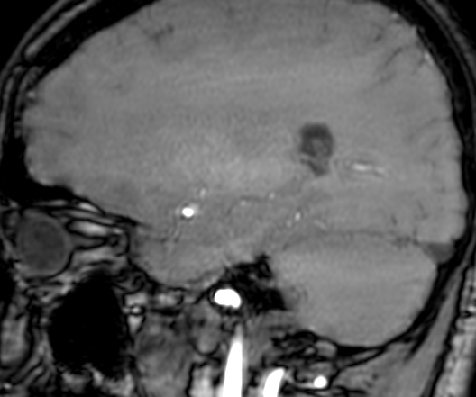 Cerebral arteriovenous malformation at posterior body of corpus callosum (Radiopaedia 74111-84925 J 270).jpg