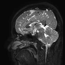 Cerebral arteriovenous malformation at posterior body of corpus callosum (Radiopaedia 74111-84925 Sagittal T2 67).jpg