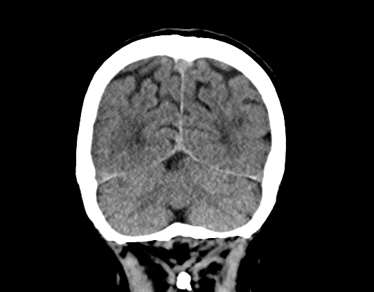 Cerebral arteriovenous malformation with lobar hemorrhage (Radiopaedia 44725-48510 Coronal non-contrast 39).png