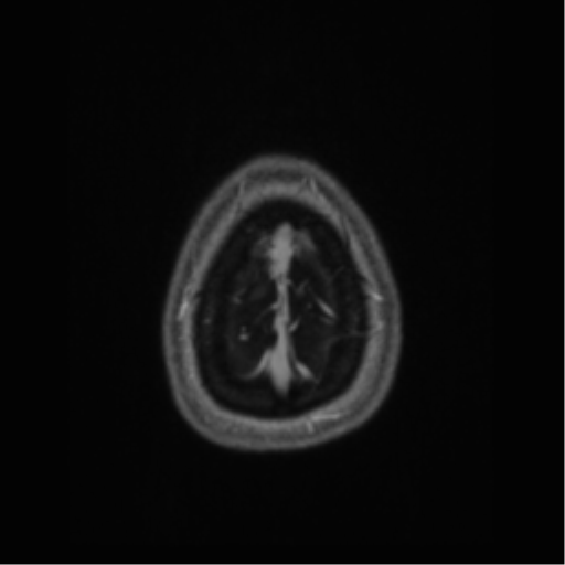 Cerebral cavernoma and development venous anomaly (Radiopaedia 37603-39482 Axial T1 C+ 73).png