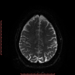 File:Cerebral cavernous malformation (Radiopaedia 26177-26306 Axial DWI 36).jpg