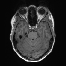 Cerebral cavernous venous malformation (Radiopaedia 70008-80021 Axial T1 22).jpg