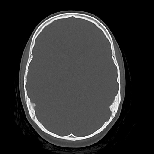 Cerebral cavernous venous malformation (Radiopaedia 70008-80022 Axial bone window 20).jpg