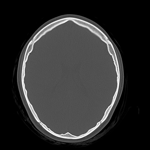 Cerebral cavernous venous malformation (Radiopaedia 70008-80022 Axial bone window 31).jpg