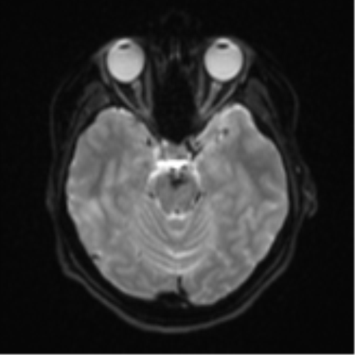 Cerebral cavernous venous malformations (Radiopaedia 48117-52946 Axial DWI 9).png