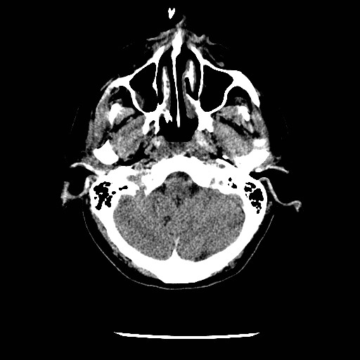 File:Cerebral edema (evolution in time) (Radiopaedia 19418-19441 non-contrast 16).jpg