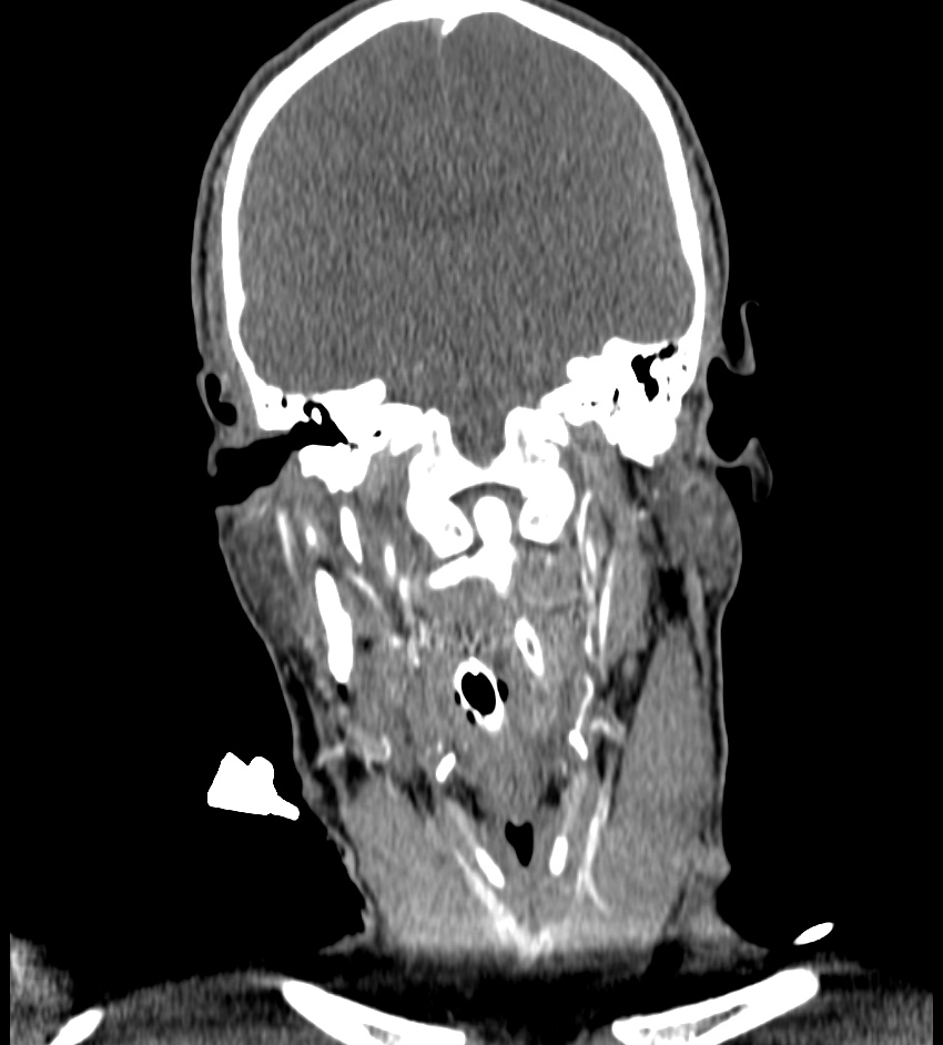 Cerebral edema in an overdose patient (Radiopaedia 72005-82539 B 67).jpg