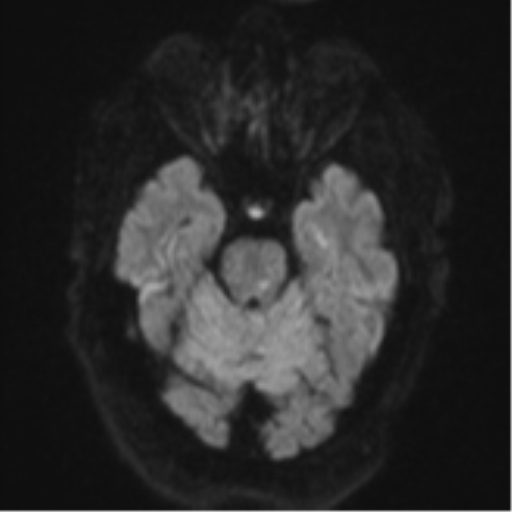 File:Cerebral embolic infarcts (embolic shower) (Radiopaedia 57395-64342 Axial DWI 48).png
