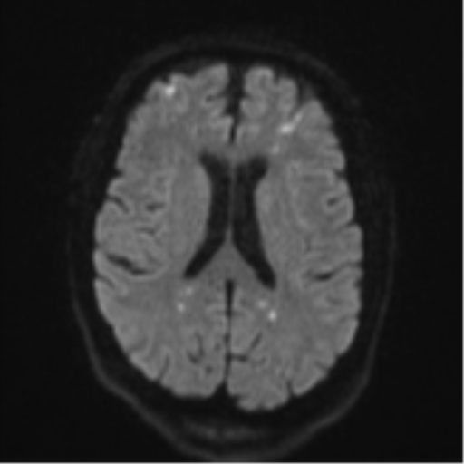 File:Cerebral embolic infarcts (embolic shower) (Radiopaedia 57395-64342 Axial DWI 58).png
