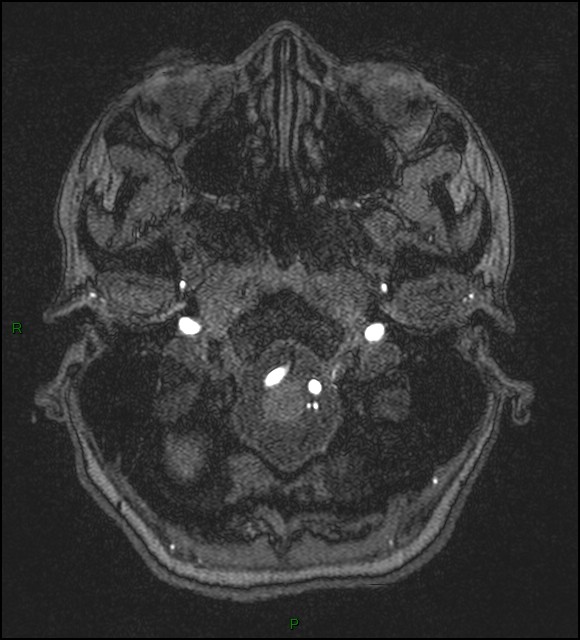 Cerebral fat embolism (Radiopaedia 35022-36525 Axial TOF 17).jpg