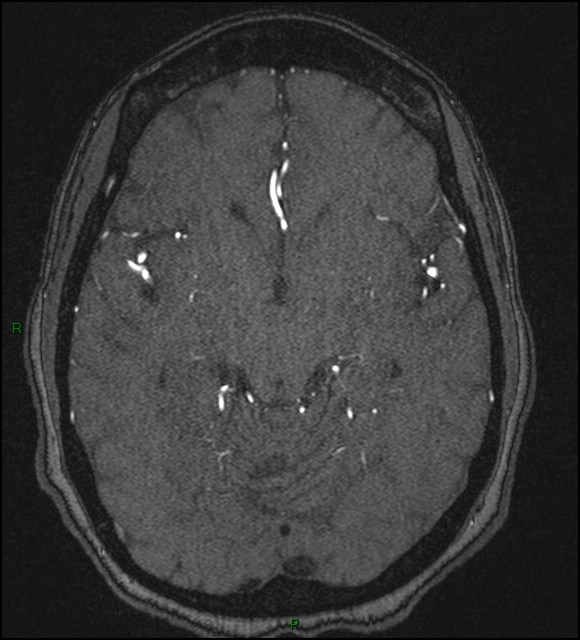Cerebral fat embolism (Radiopaedia 35022-36525 Axial TOF 89).jpg
