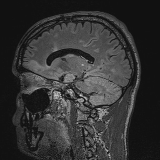 File:Cerebral hemorrhagic contusions- temporal evolution (Radiopaedia 40224-42757 Sagittal T1 33).png