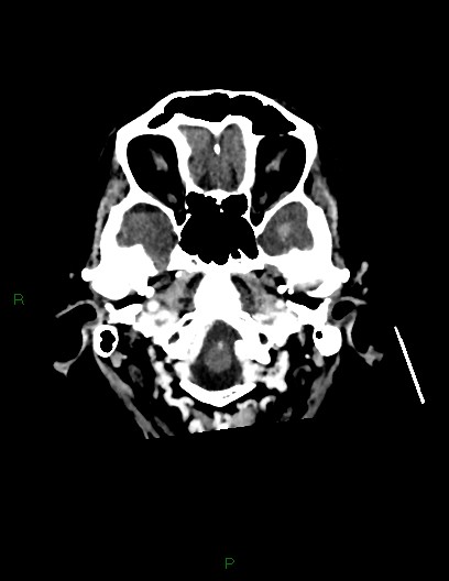 Cerebral metastases - ependymal and parenchymal (Radiopaedia 79877-93131 Axial C+ delayed 8).jpg