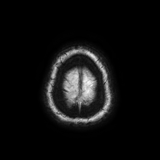 Cerebral metastases - melanoma (Radiopaedia 80972-94522 Axial SWI 95).jpg