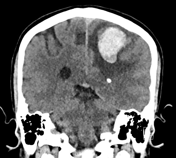 Cerebral metastases - testicular choriocarcinoma (Radiopaedia 84486-99855 Coronal C+ delayed 41).jpg