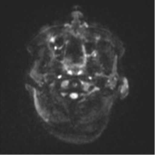 Cerebral metastases mimicking abscesses (Radiopaedia 45841-50131 Axial DWI 29).png