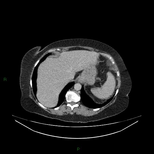 Cerebral metastasis from renal cell carcinoma (Radiopaedia 82306-96378 A 27).jpg