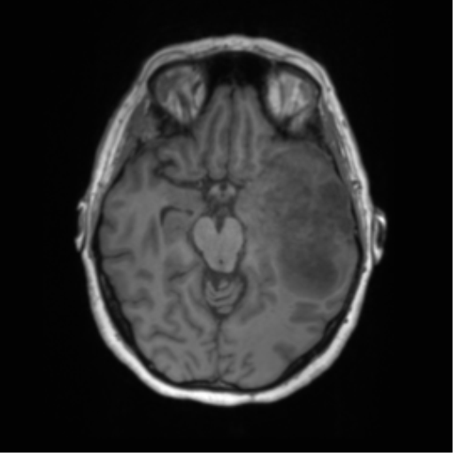 Cerebral metastasis mimicking glioblastoma (Radiopaedia 69155-78937 Axial T1 23).png