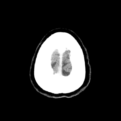 Cerebral metastasis to basal ganglia (Radiopaedia 81568-95412 Axial C+ delayed 53).png