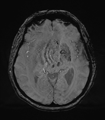 Cerebral metastasis to basal ganglia (Radiopaedia 81568-95413 Axial SWI 38).png