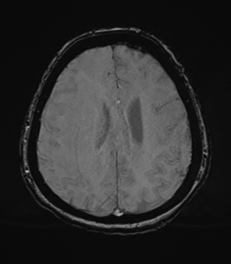 Cerebral metastasis to basal ganglia (Radiopaedia 81568-95413 Axial SWI 62).png