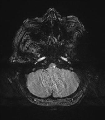 Cerebral metastasis to basal ganglia (Radiopaedia 81568-95413 Axial SWI magnitude 13).png