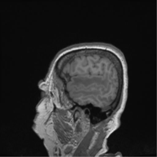 Cerebral metastasis to basal ganglia (Radiopaedia 81568-95413 Sagittal T1 68).png