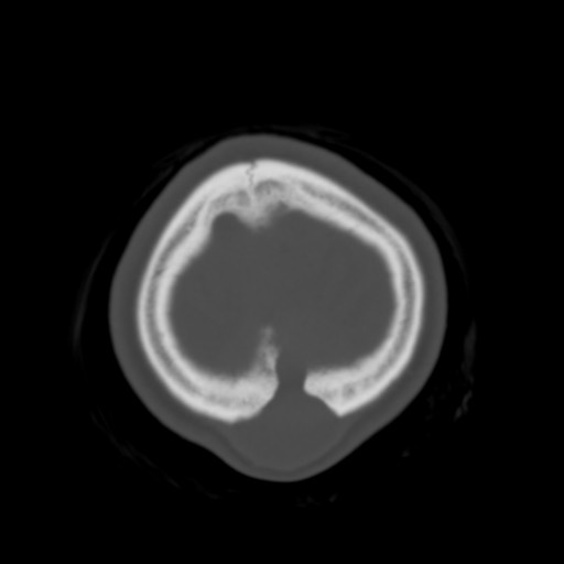 Cerebral tuberculosis with dural sinus invasion (Radiopaedia 60353-68018 Axial bone window 60).jpg