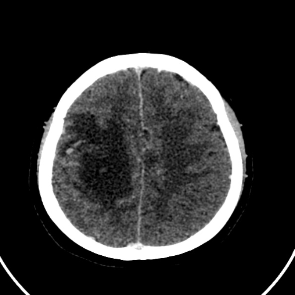File:Cerebral venous hemorrhagic infarct from venous sinus thrombosis (Radiopaedia 55433-61883 Axial C+ delayed 44).jpg