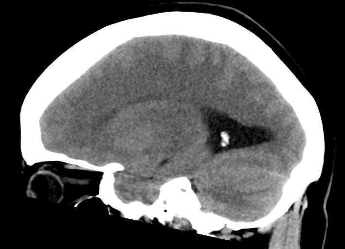 File:Cerebral venous infarct related to dural venous sinus thromboses (Radiopaedia 35292-36803 Sagittal 11).png