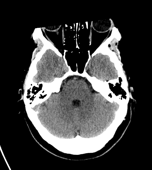 File:Cerebral venous infarct related to dural venous sinus thromboses (Radiopaedia 35292-36804 Axial non-contrast 9).png