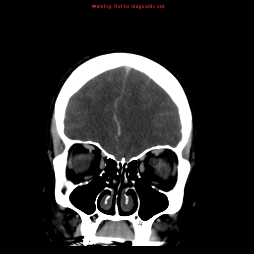 Cerebral venous infarction (Radiopaedia 12404-20735 B 17).jpg