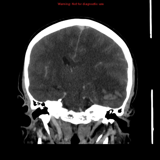 Cerebral venous infarction (Radiopaedia 12404-20735 B 44).jpg