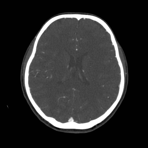 Cerebral venous sinus thrombosis (Radiopaedia 40619-43227 A 136).jpg