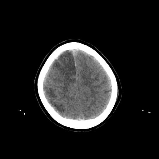 File:Cerebral venous throbmosis - hemorrhagic venous infarction (Radiopaedia 87318-103613 Axial non-contrast 144).jpg