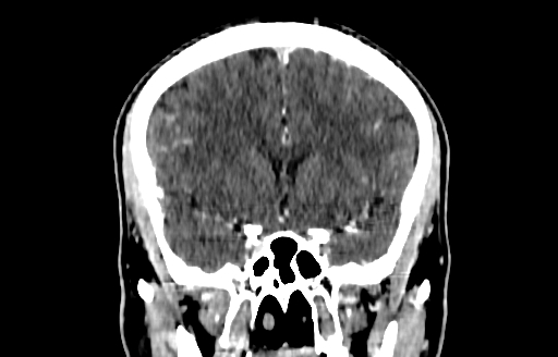 Cerebral venous thrombosis (CVT) (Radiopaedia 77524-89685 C 23).jpg