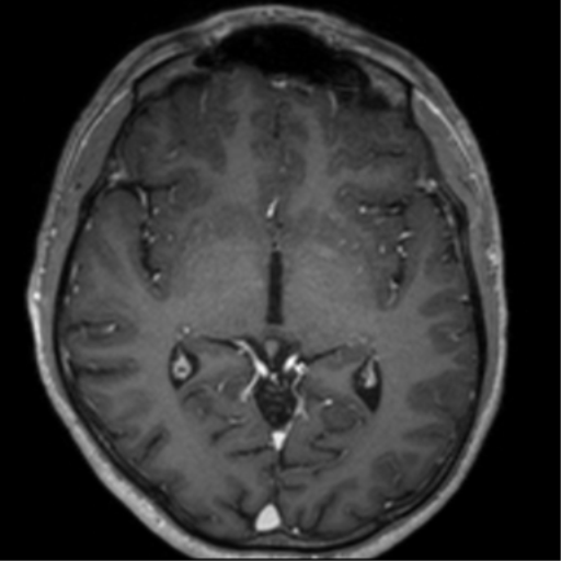 Cerebral venous thrombosis (Radiopaedia 38392-40469 Axial T1 C+ 39).png