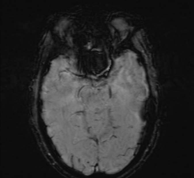 Cerebral venous thrombosis (Radiopaedia 71207-81504 Axial SWI 19).jpg